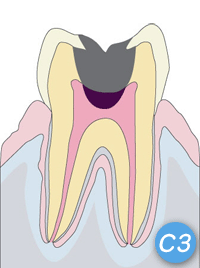 むし歯の進行と治療